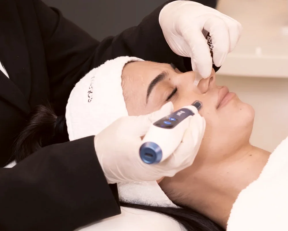 Microneedling Zalm DNA bij Zina Beauty